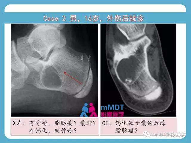 【PPT】跗骨病变影像分析思路(续)
