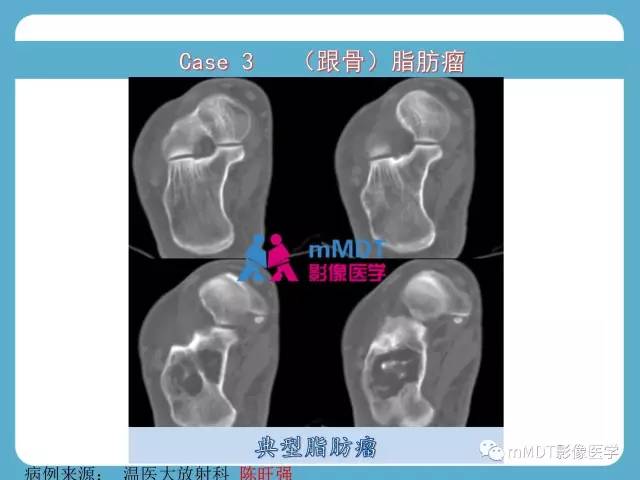 【PPT】跗骨病变影像分析思路(续)
