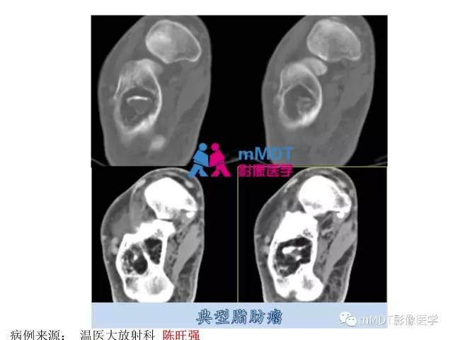 【PPT】跗骨病变影像分析思路(续)