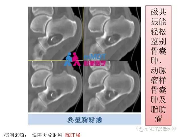 【PPT】跗骨病变影像分析思路(续)
