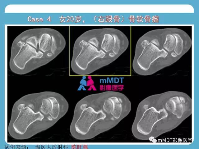 【PPT】跗骨病变影像分析思路(续)