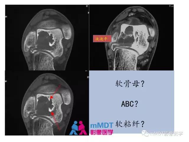 【PPT】跗骨病变影像分析思路(续)