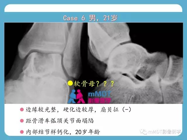 【PPT】跗骨病变影像分析思路(续)
