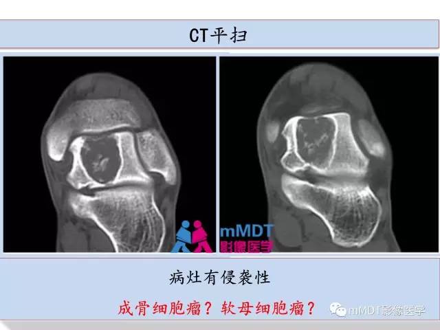 【PPT】跗骨病变影像分析思路(续)