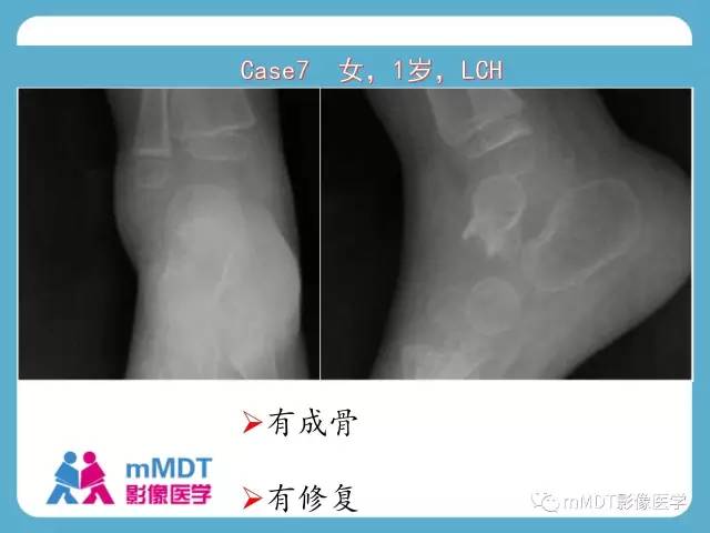 【PPT】跗骨病变影像分析思路(续)