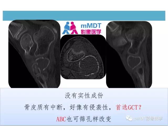【PPT】跗骨病变影像分析思路(续)