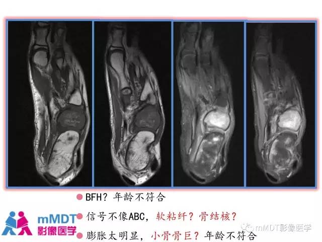 【PPT】跗骨病变影像分析思路(续)