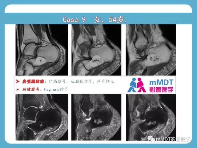 【PPT】跗骨病变影像分析思路(续)