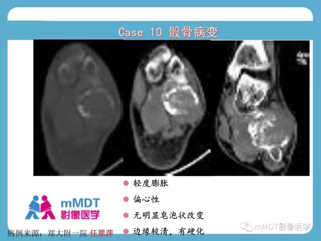 【PPT】跗骨病变影像分析思路(续)