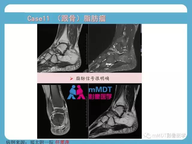 【PPT】跗骨病变影像分析思路(续)