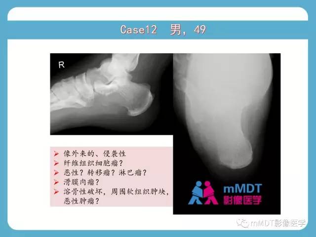 【PPT】跗骨病变影像分析思路(续)
