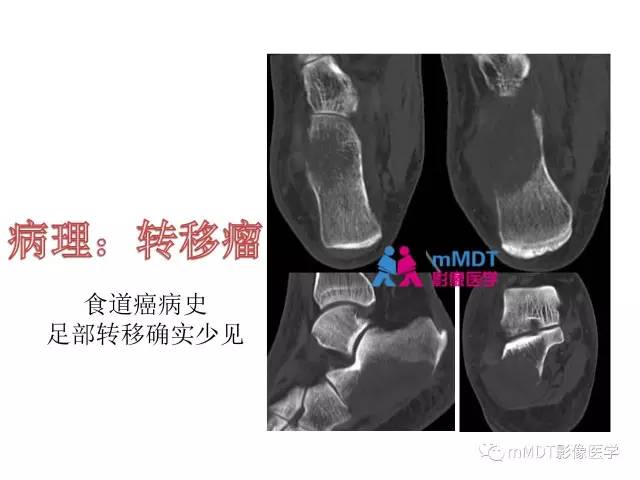 【PPT】跗骨病变影像分析思路(续)