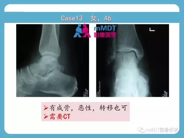 【PPT】跗骨病变影像分析思路(续)