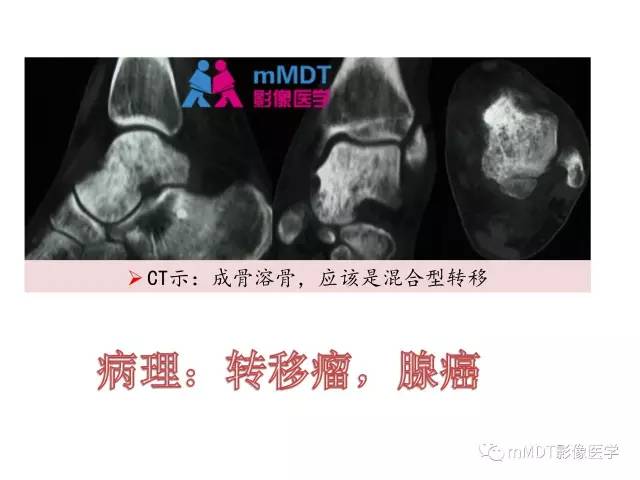 【PPT】跗骨病变影像分析思路(续)