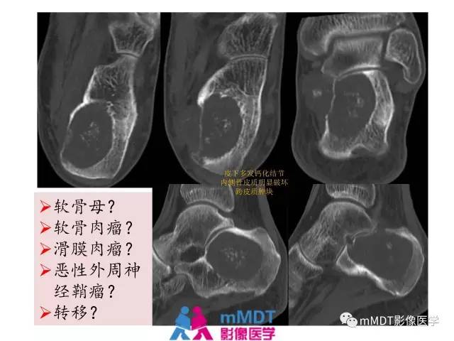 【PPT】跗骨病变影像分析思路(续)