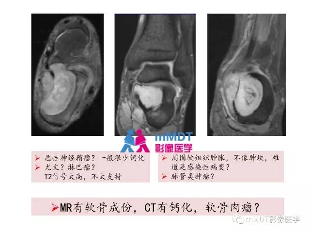 【PPT】跗骨病变影像分析思路(续)