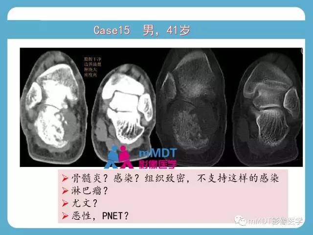 【PPT】跗骨病变影像分析思路(续)