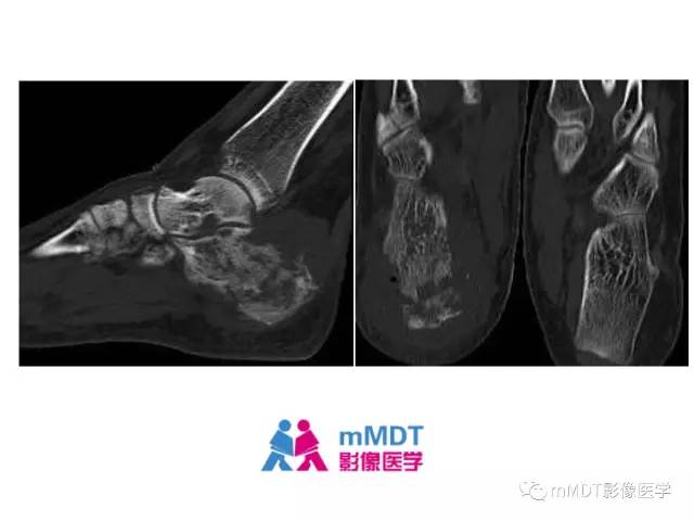 【PPT】跗骨病变影像分析思路(续)