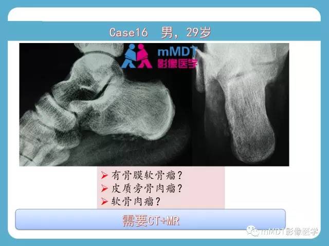 【PPT】跗骨病变影像分析思路(续)