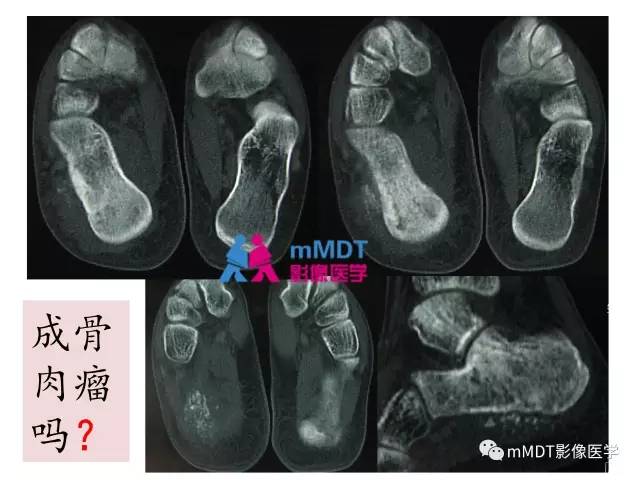 【PPT】跗骨病变影像分析思路(续)