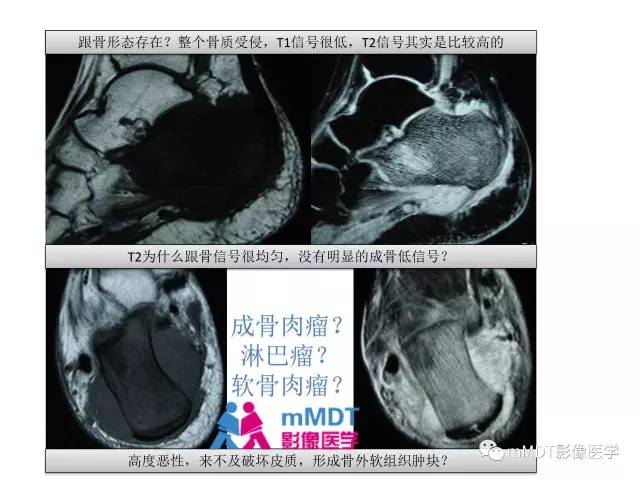 【PPT】跗骨病变影像分析思路(续)