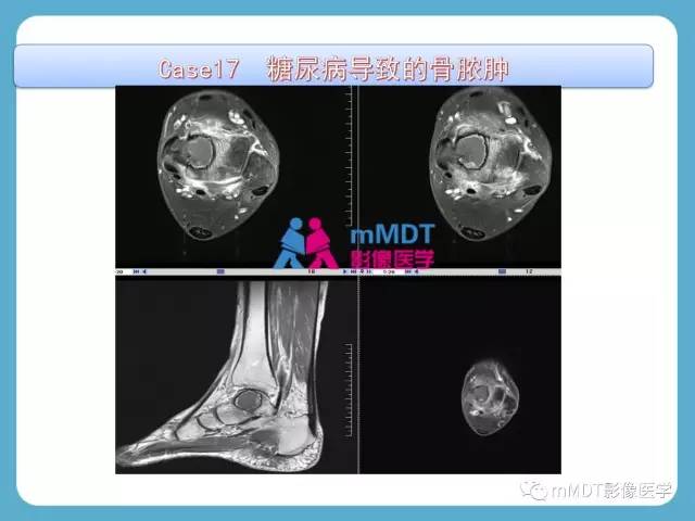 【PPT】跗骨病变影像分析思路(续)