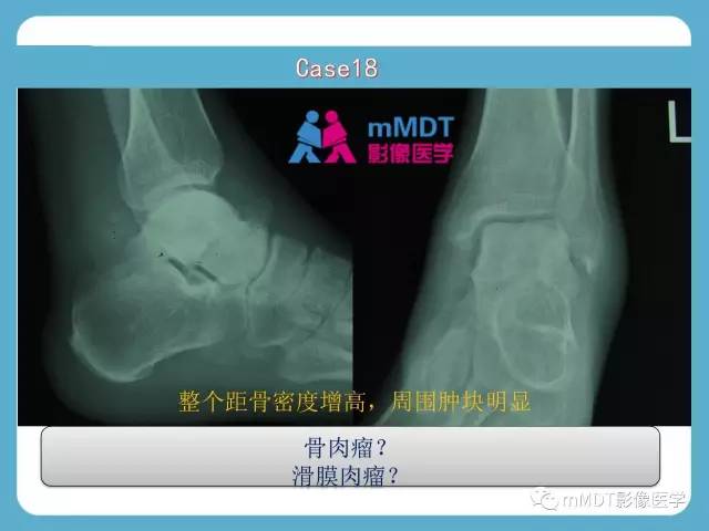 【PPT】跗骨病变影像分析思路(续)