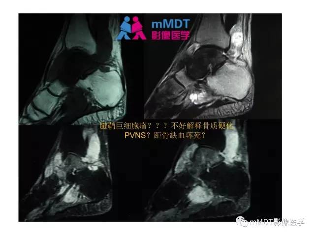 【PPT】跗骨病变影像分析思路(续)
