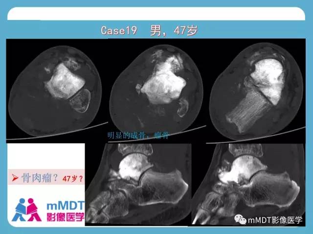 【PPT】跗骨病变影像分析思路(续)