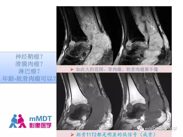 【PPT】跗骨病变影像分析思路(续)