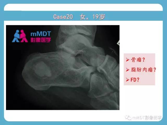 【PPT】跗骨病变影像分析思路(续)