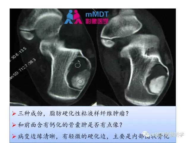 【PPT】跗骨病变影像分析思路(续)