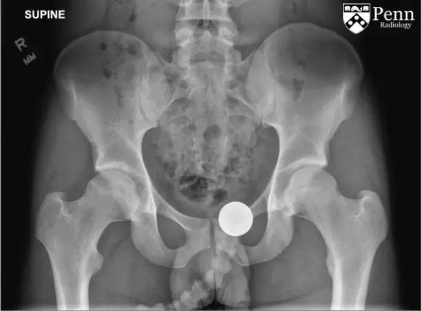 【双语病例】髋臼骨样骨瘤1例X线CT 【双语病例】髋臼骨样骨瘤1例X线CT