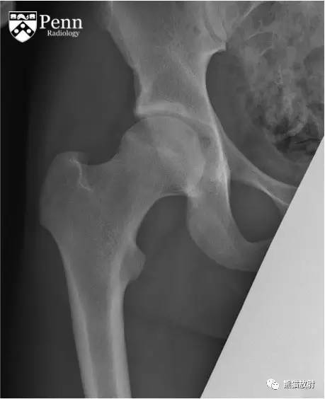 【双语病例】髋臼骨样骨瘤1例X线CT 【双语病例】髋臼骨样骨瘤1例X线CT