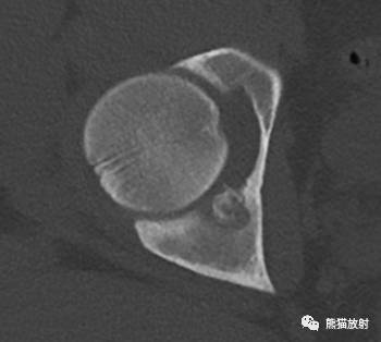 【双语病例】髋臼骨样骨瘤1例X线CT