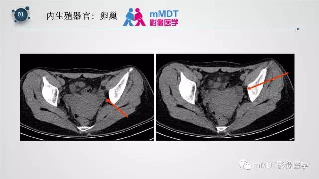 【PPT】子宫附件影像解剖