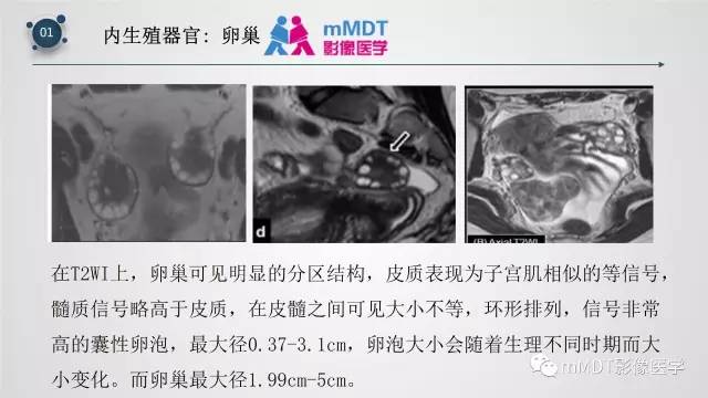 【PPT】子宫附件影像解剖