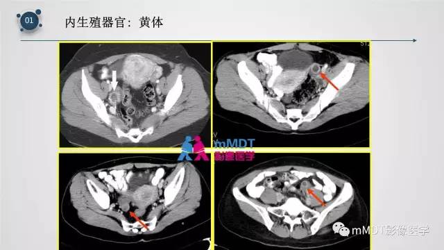 【PPT】子宫附件影像解剖