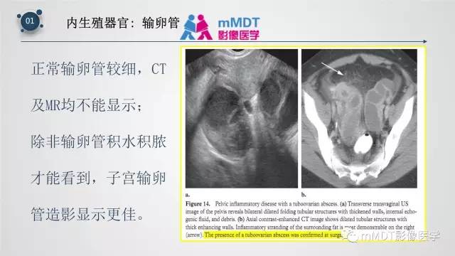 【PPT】子宫附件影像解剖
