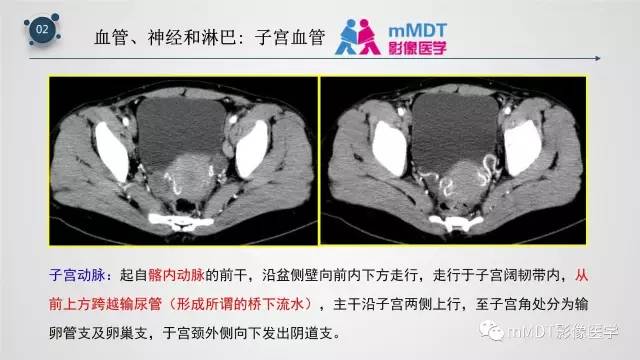 【PPT】子宫附件影像解剖