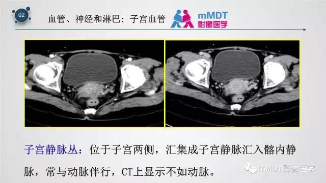 【PPT】子宫附件影像解剖
