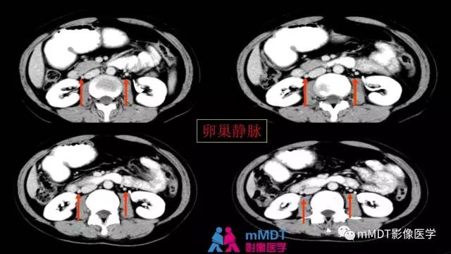 【PPT】子宫附件影像解剖