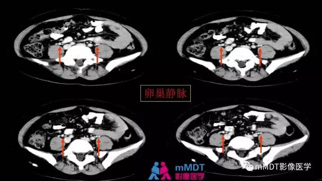 【PPT】子宫附件影像解剖