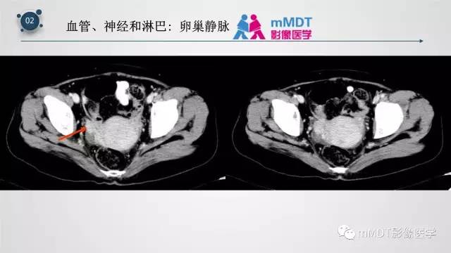 【PPT】子宫附件影像解剖