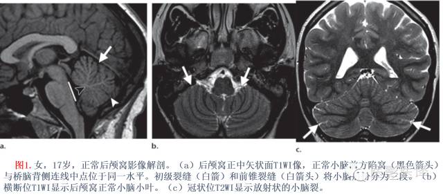 后颅窝先天性异常的影像学表现 后颅窝先天性异常的影像学表现