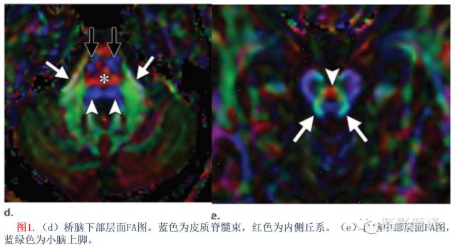 后颅窝先天性异常的影像学表现 后颅窝先天性异常的影像学表现