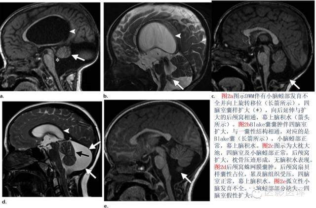 后颅窝先天性异常的影像学表现 后颅窝先天性异常的影像学表现
