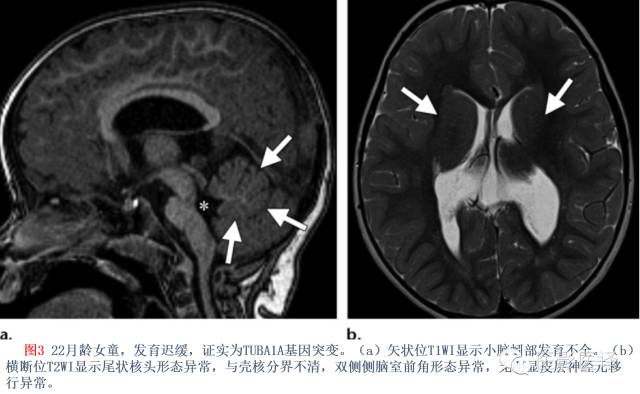 后颅窝先天性异常的影像学表现 后颅窝先天性异常的影像学表现