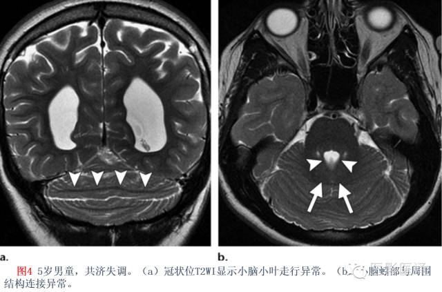 后颅窝先天性异常的影像学表现 后颅窝先天性异常的影像学表现