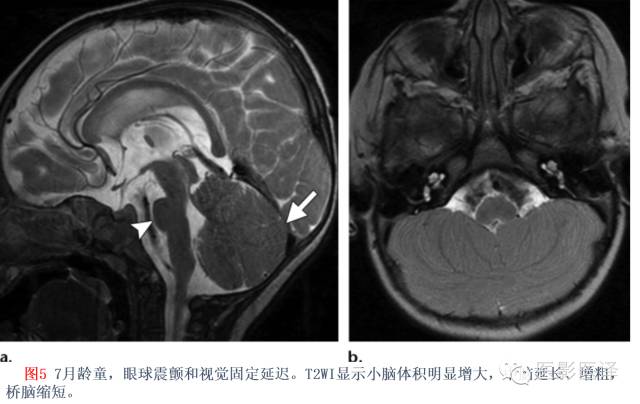 后颅窝先天性异常的影像学表现 后颅窝先天性异常的影像学表现
